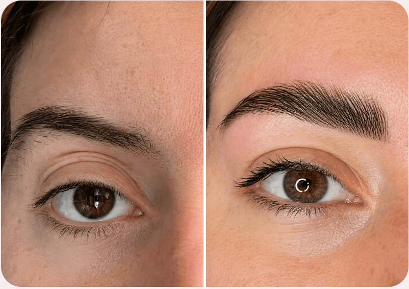 Brow Lift coréen